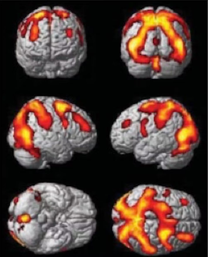 Imagen cerebral cuando el individuo se siente en peligro (aparición de la imagen de una serpiente) / Imagen: Fourni par l'auteur