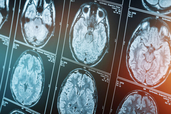 Científicos afirman que tienes un ‘cerebro adolescente’ hasta los 32 años