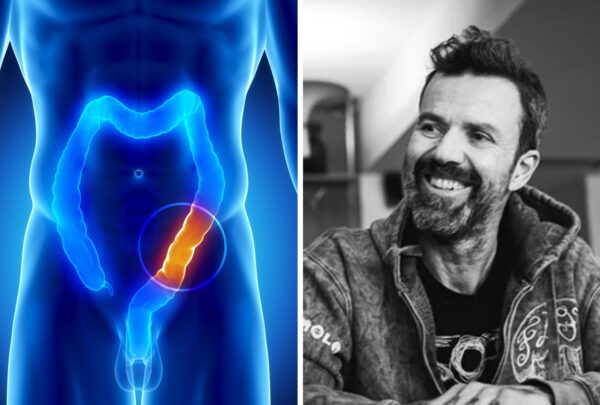 4 síntomas de cáncer de colon que no debes ignorar (aunque seas joven)